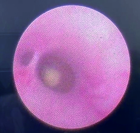 唾液線內視鏡下結石於導管中